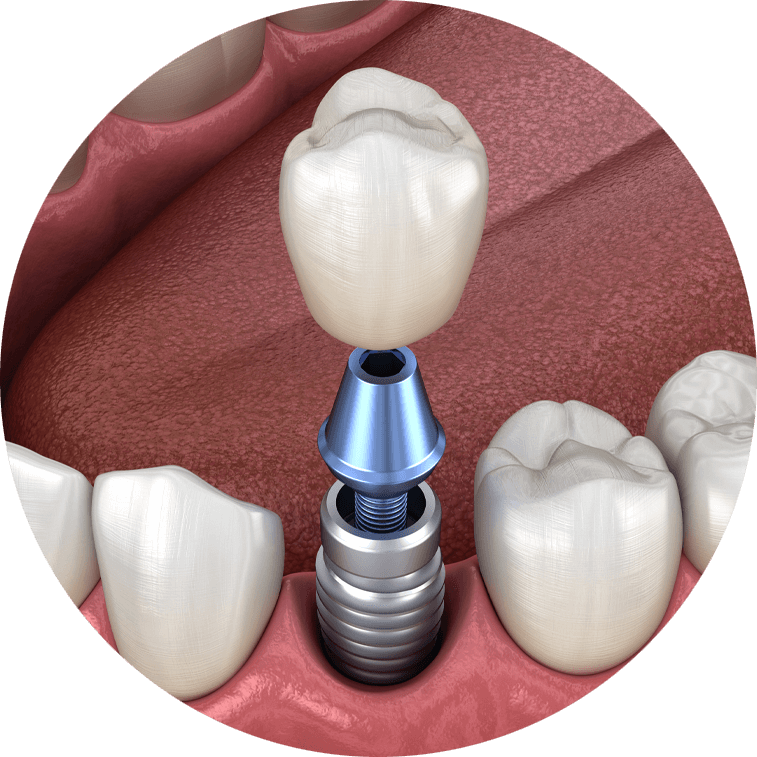 single dental implant model 2