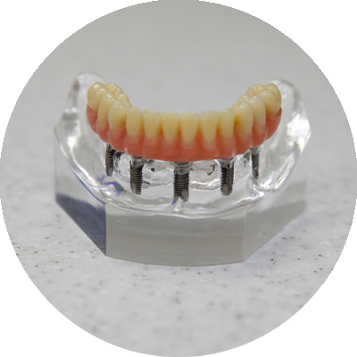 full arch implant model on counter