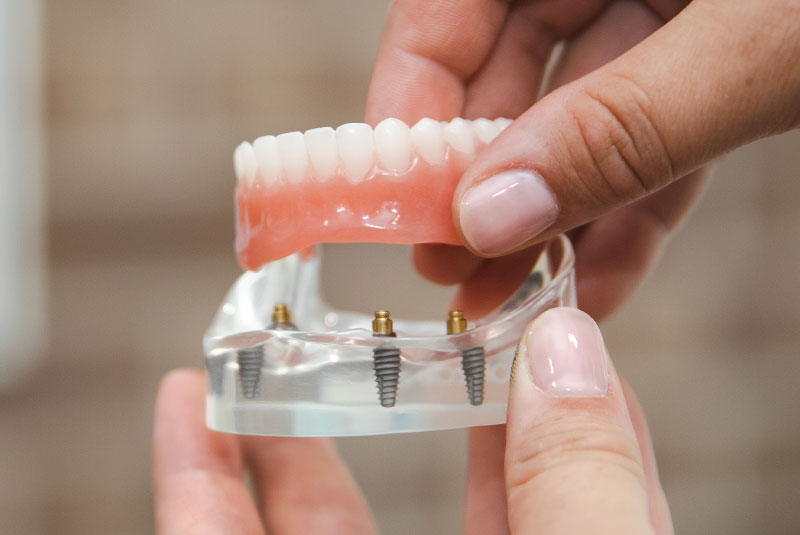 full arch model being shown to patient