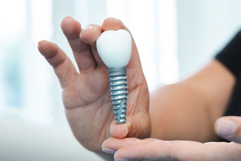 Large dental implant model